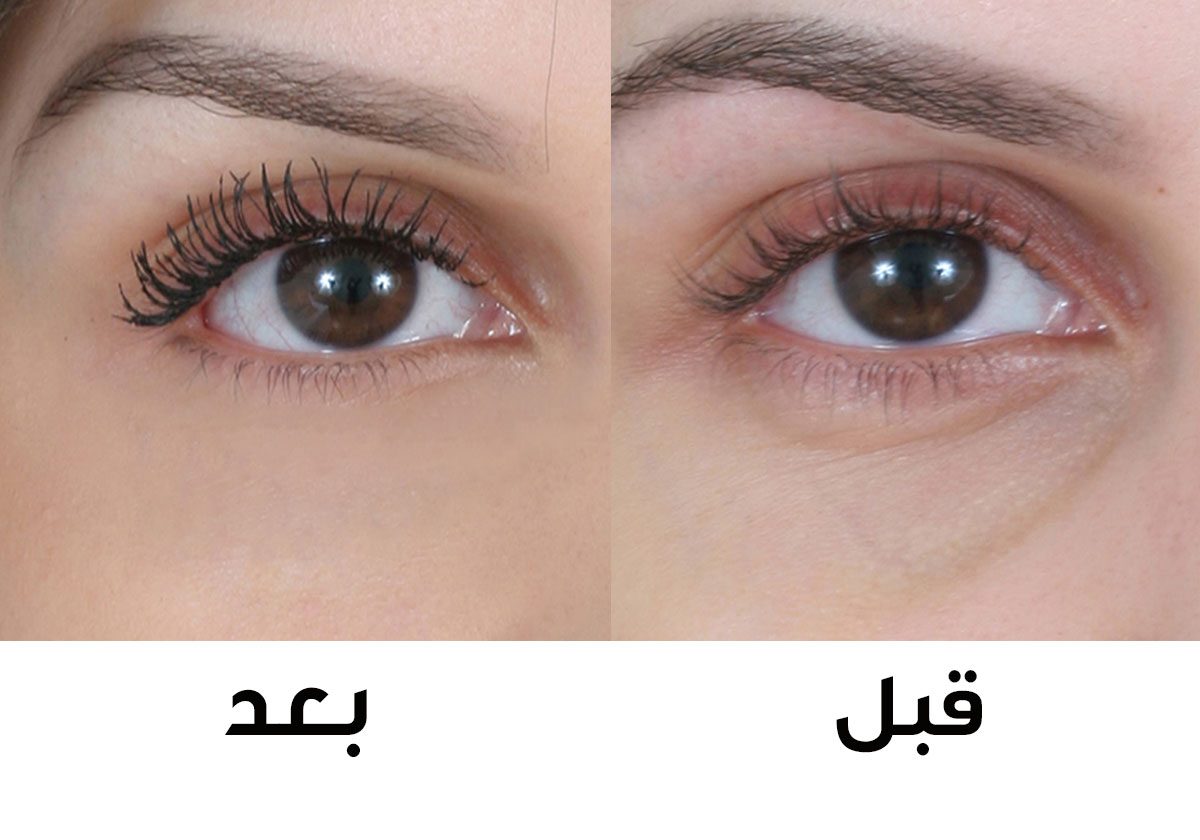 معالجة تجوير تحت العين - Thelaserclinic.co